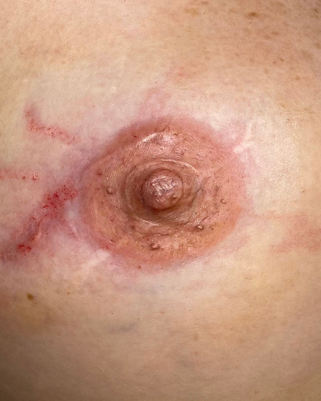 Eksempel på areola-pigmentering